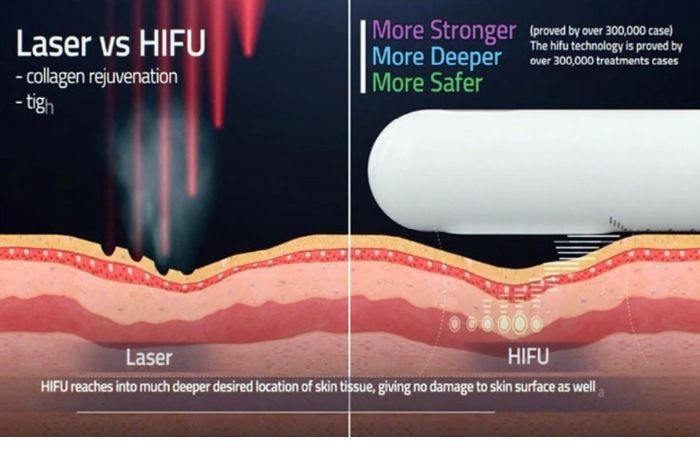 Công nghệ Hifu vượt trội hơn công nghệ Laser cũ trong thẩm mỹ vùng kín