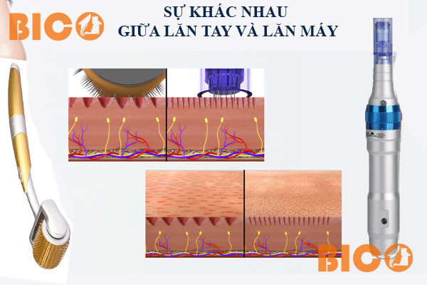 ưu điểm phi kim bằng máy soi với lăn bằng kim lăn tay