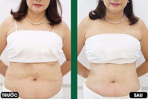 giảm mỡ bụng bằng laser lipo