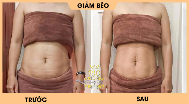 Giảm béo bụng sau sinh bằng công nghệ laser cavitation