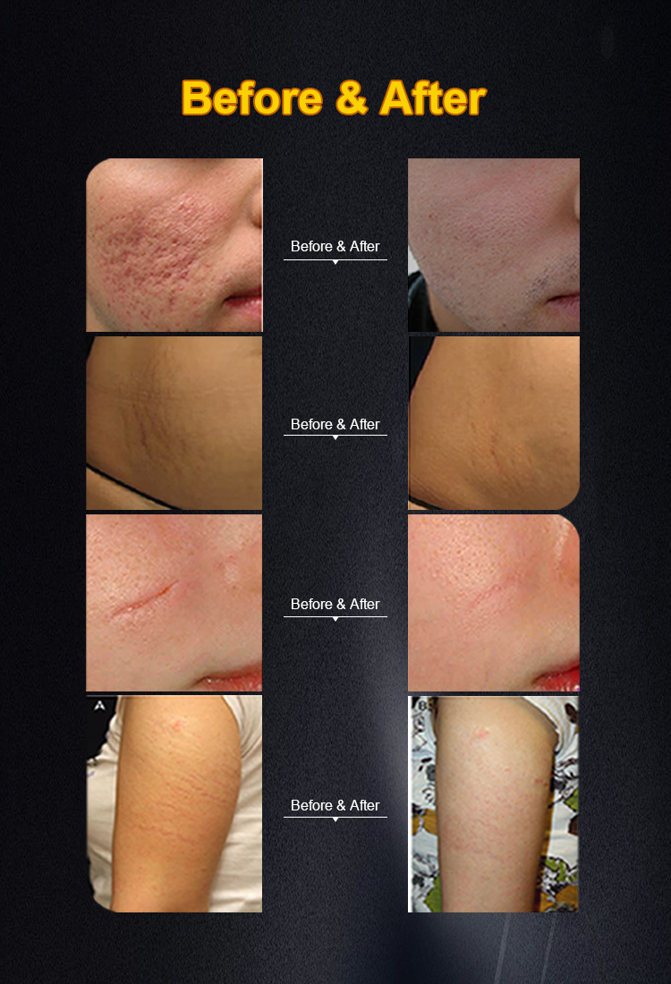 Hiệu quả của máy laser co2 fractional