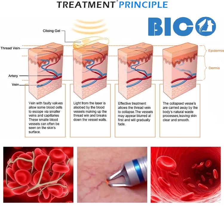 Hình ảnh Laser Điều Trị Giãn Mao Mạch