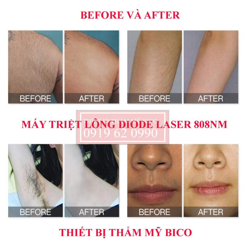 Công dụng máy Triệt Lông Diode Hr Laser 808nm Hãng FQbeauty