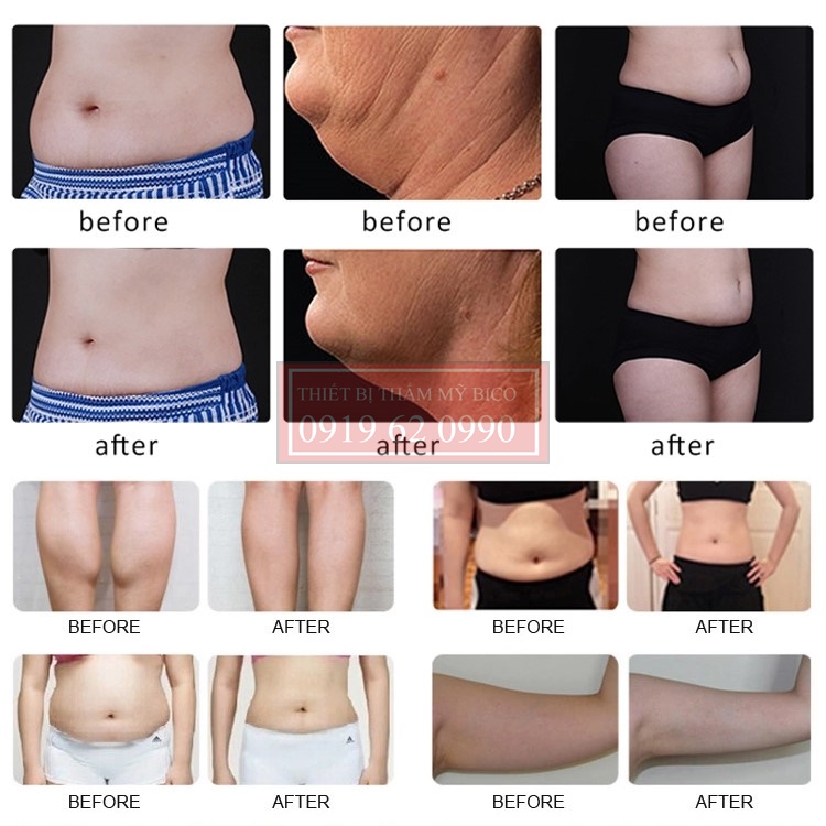 ảnh trước và sau khi dùng công gnheej giảm béo