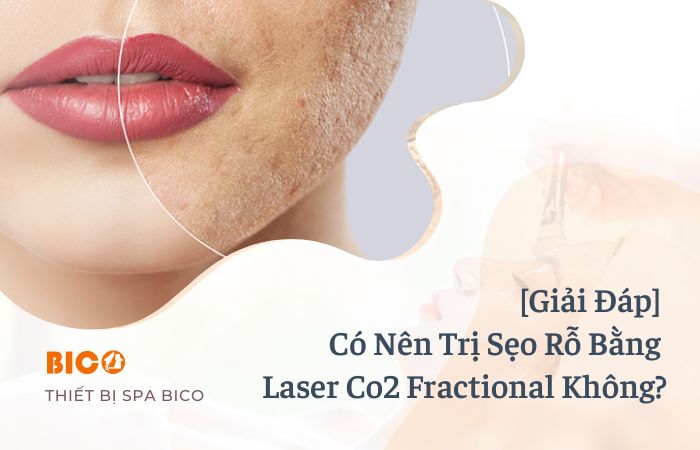 PGiải Đáp] Có Nên Trị Sẹo Rỗ Bằng Laser Co2 Fractional Không?