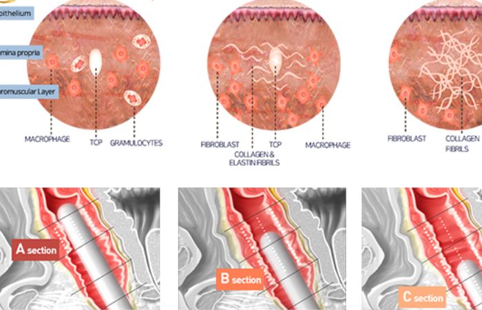 Máy Hifu giúp trẻ hóa se khít âm đạo hiệu quả