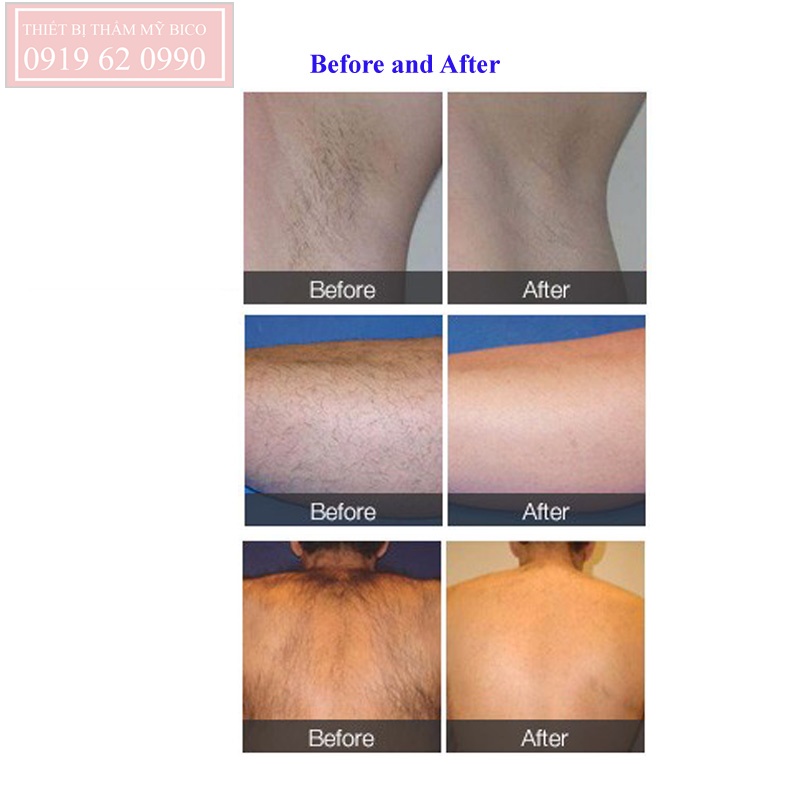 Trước và sau điều trị triệt lông bằng máy FQA32-3