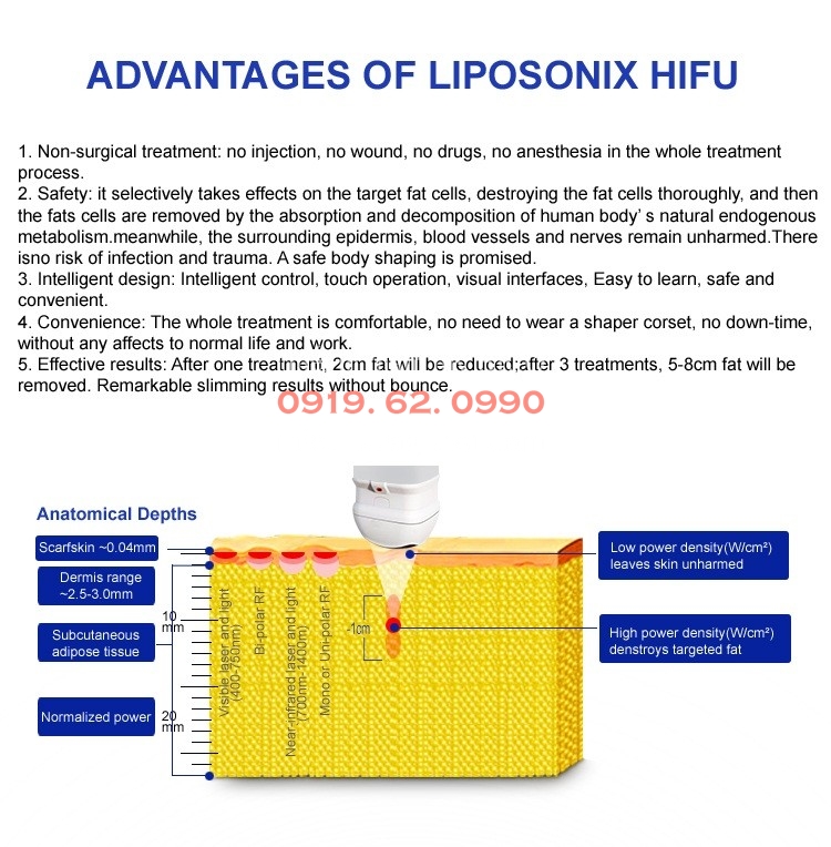 Nguyên lý hoạt động của sống siêu âm cường độ cao HIFU trong máy giảm béo LIPO HIFU