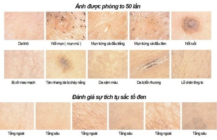 Xác định tình trạng da thông qua các dấu hiệu được phát hiện bởi máy soi da